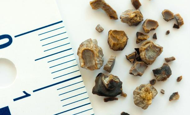 有什么食物可以預防結(jié)石的形成？深圳送菜公司?為您解讀